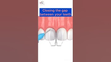 Closing Teeth gaps with Composite Filling #process #teethgap #teeth