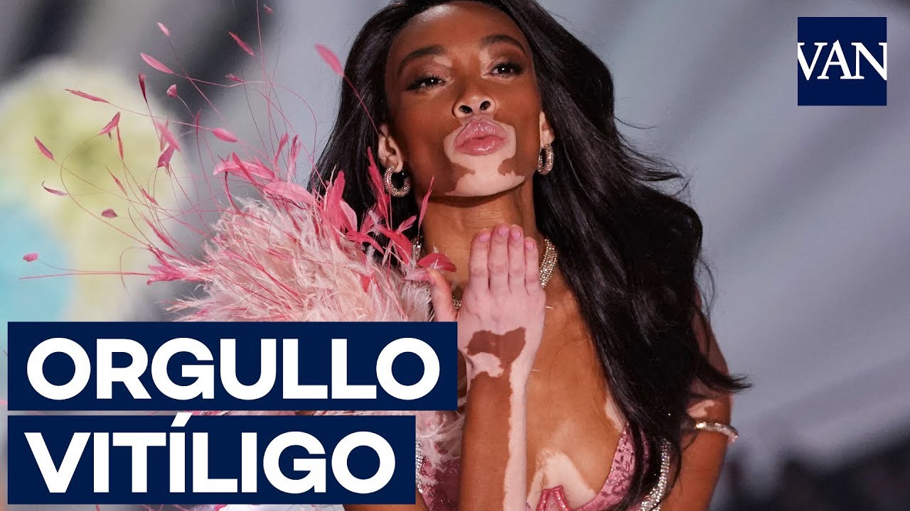 Victoria's Secret 2018] Winnie Harlow, la primer modelo con vitíligo en  desfilar - YouTube