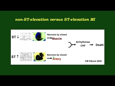 Video: Pressure In Myocardial Infarction: Increases Or Decreases, The Norm