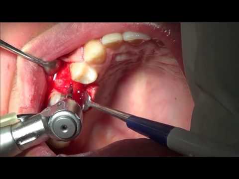 Cirurgia de implante dentário unitário