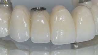 Creating Individual-Looking Teeth On A Full-Arch Bridge | Dental Lab Learning