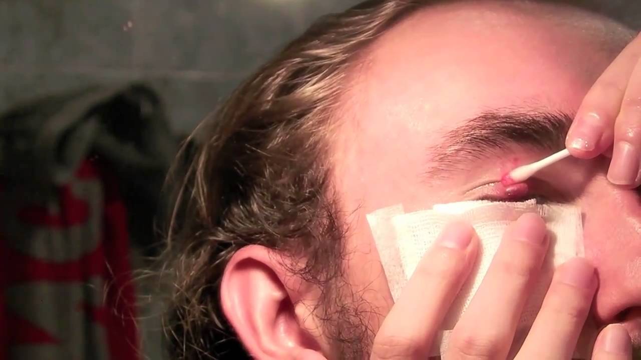 Bloody chalazion pus release youtube Stue skab