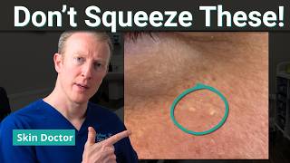 Milia: How to Get Rid of Those Tiny White Bumps Under Your Eyes