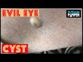 A Cyst Giving the Evil Eye