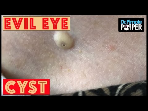 A Cyst Giving The Evil Eye