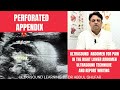 Appendicitis ultrasound | appendix ultrasound normal vs abnormal | appendix ultrasound technique