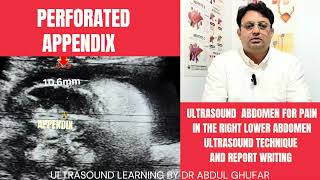 Appendicitis ultrasound | appendix ultrasound normal vs abnormal | appendix ultrasound technique