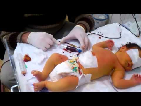 عملية تبديل دم لطفل عمره 48 ساعة 30 12 2013