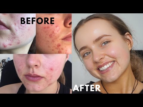 HOW I CLEARED MY ACNE AFTER YEARS OF TRYING | Skin Care Routine | Conagh Kathleen