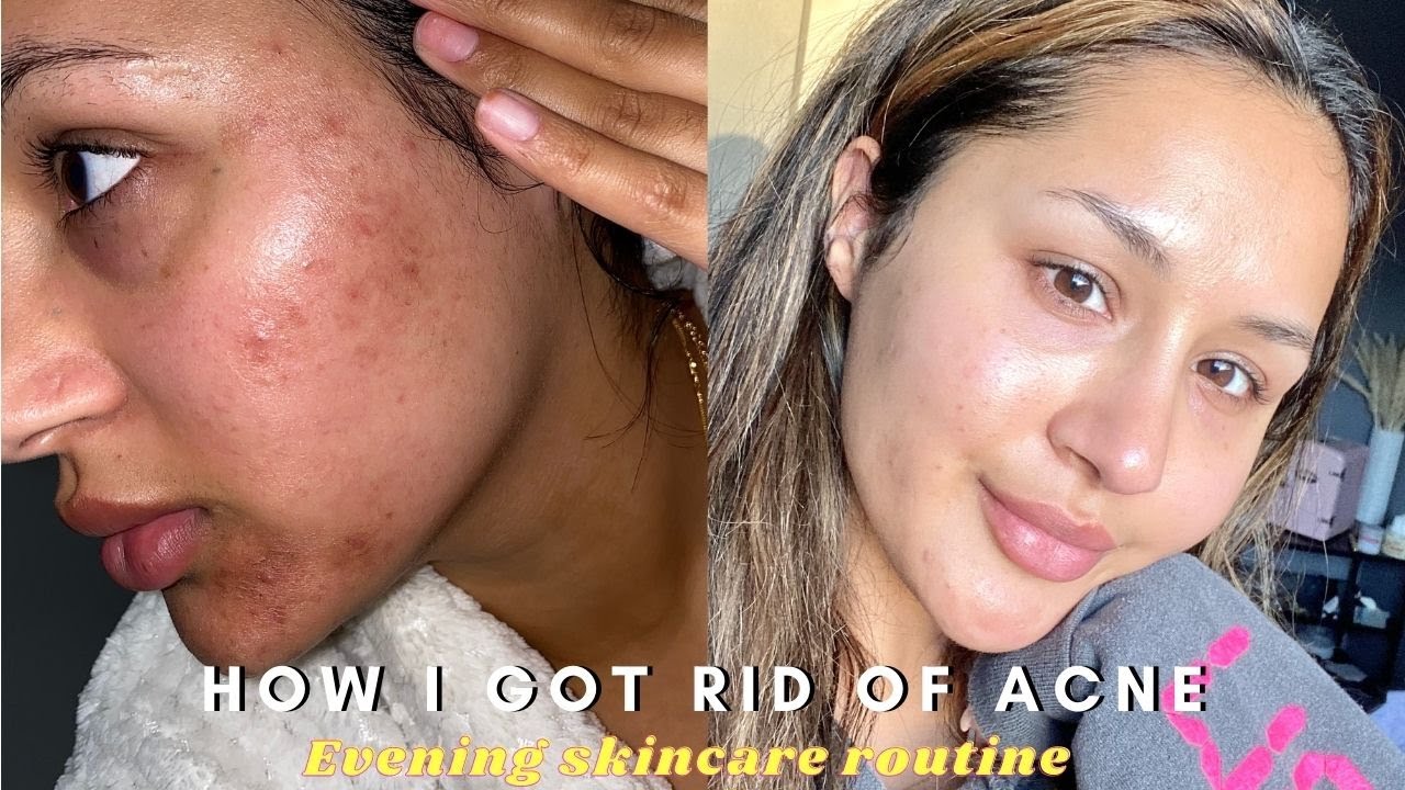 Evening Skincare routine - How I got rid of my acne - YouTube