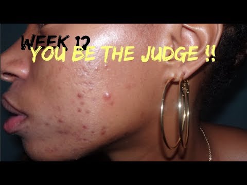 ITS BEEN 12 WEEKS USING DIFFERIN ACNE GEL