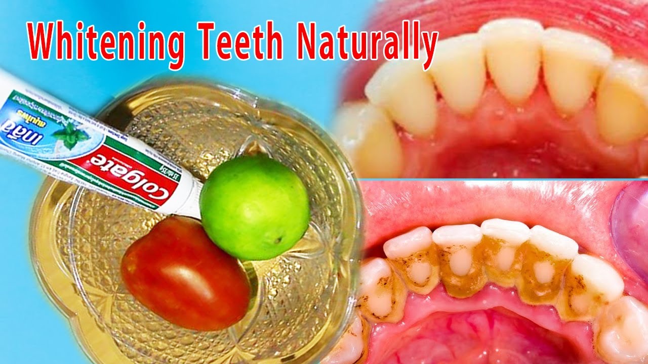 How To Make Natural Whitening For Teeth. Get Teeth Whiten