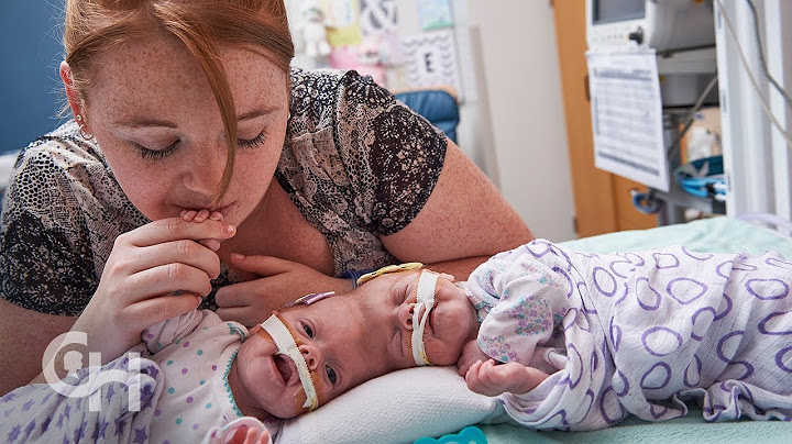 Conjoined Twins Abby and Erin Delaney: A Year in the Life