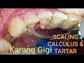 TARTAR & CALCULUS. Pembersihan Karang Gigi Penyebab Bau Mulut, Setelah Dibersihkan Nafas Jadi Segar