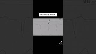 aprenda ler um ECG com Bloqueio de ramo esquerdo!!! última chance !! #cardiology #lastacall aprenda ler um ECG com Bloqueio de ramo esquerdo!!! última chance !! #cardiology #lastacall