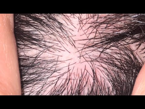 ASMR ingrown hair sounds good 👍 | ingrown hairs satisfying vedio | episode 2 ingrown 10 ingrown
