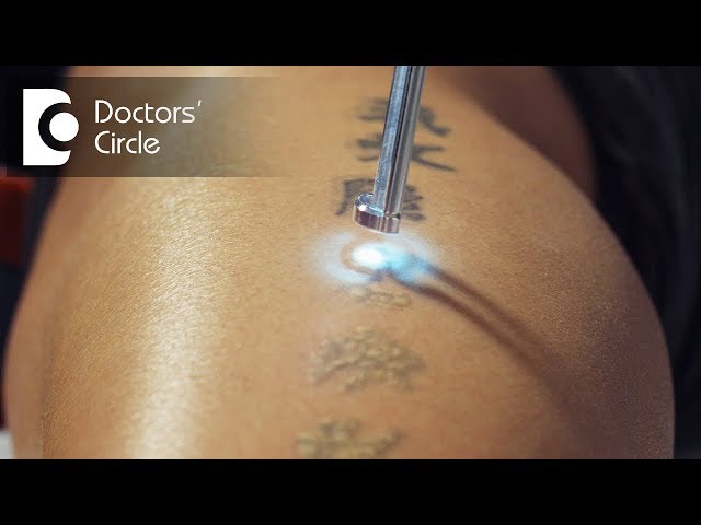 Why Picosecond Laser Is A Boon To Tattoo Removal? - VCare
