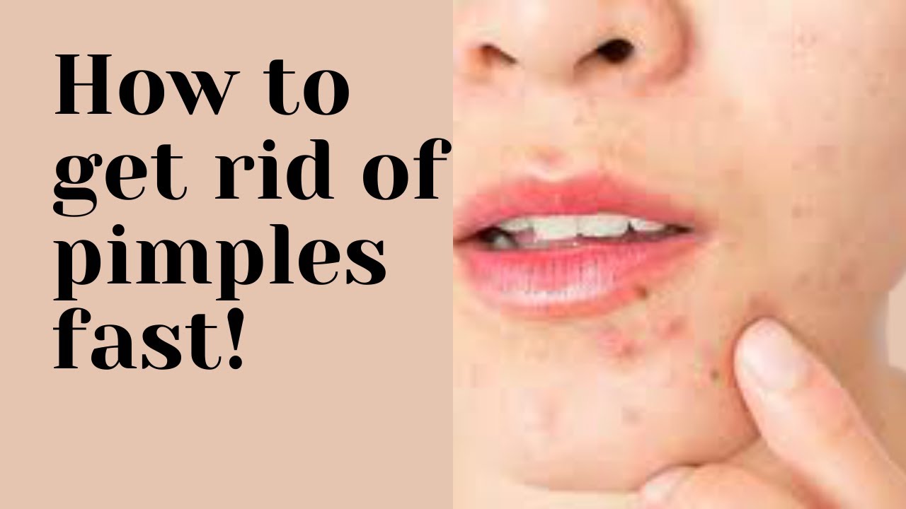 How To Get Rid Of Pimples Fast Easy Ways To Dry Out Your Acne In