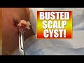 Cyst with Sac Removed - Looks Like Cauliflower