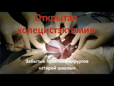 Открытая холецистэктомия: техника операции