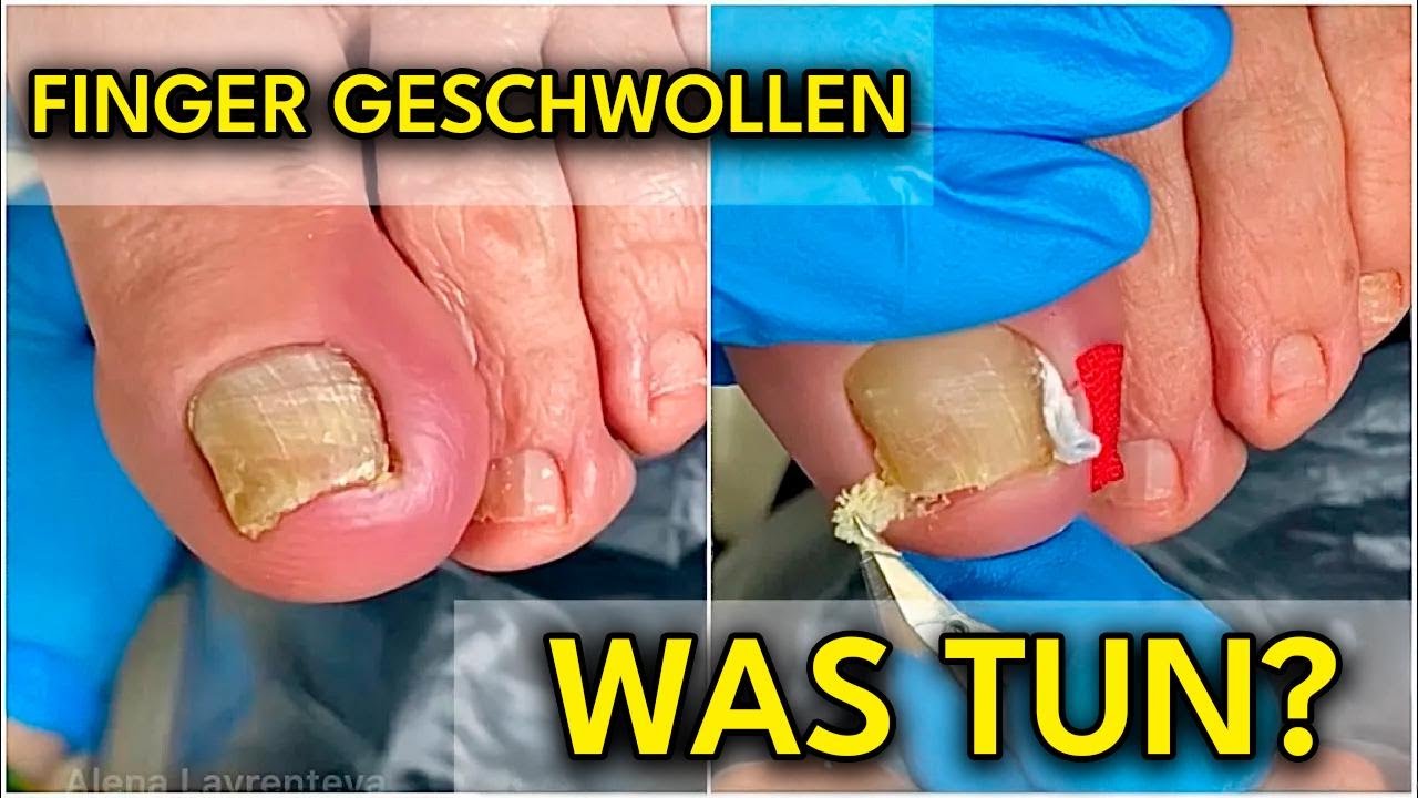Schne Geschwollener Finger Was Tun Ebenbild