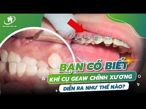 Video Kĩ thuật Geaw Trong Niềng Răng - 