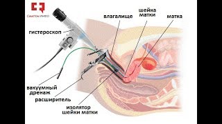 Миома матки: лечение гистероскопической энуклеацией или операция удаления лазером