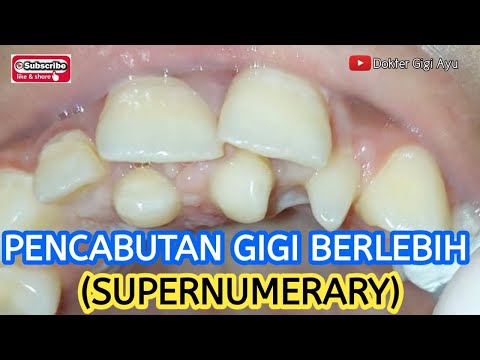 Video: Adakah gigi supernumerary genetik?