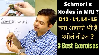 What are Schmorl's Nodes? Herniated Disc, 3 Exercises for Lower Back Pain Relief, Disc Degeneration