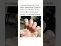 a hand with Anonychia