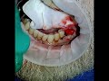 Management of a bleed 6 days after dental extraction with gelfoam and tranexamic acid