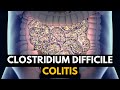 CLOSTRIDIUM DIFFICILE COLITIS, Causes, Signs and Symptoms, Diagnosis and Treatment.