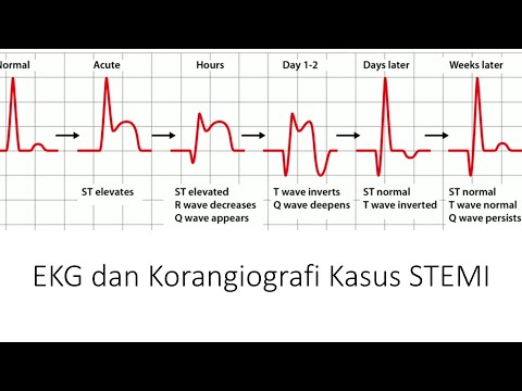 Video: Kapan kasus koroner?