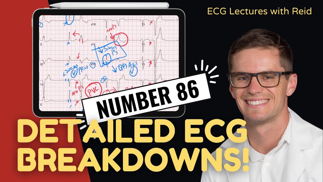 EKG Test Yourself | ECG Case Study #86 - YouTube