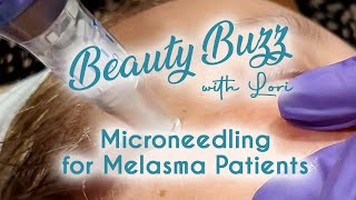 Beauty Buzz with Lori: Microneedling for Melasma Patients