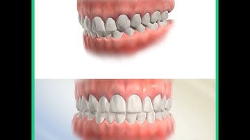 Niềng Răng Hô Diễn Ra Như Thế Nào? || Bác sĩ Yến Yteeth