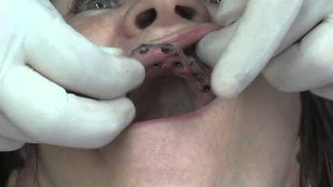 Primary Bar Insertion