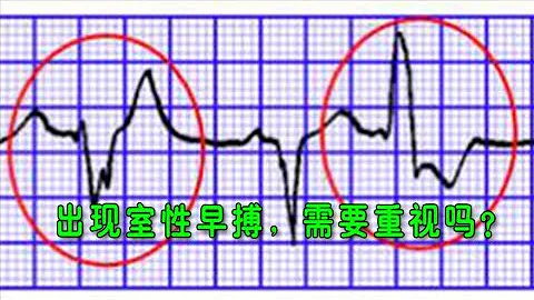 室性早搏，真的是死亡信號嗎？醫生總結：這種人需要重視！分不同情況講解不同的治療方法 - 天天要聞