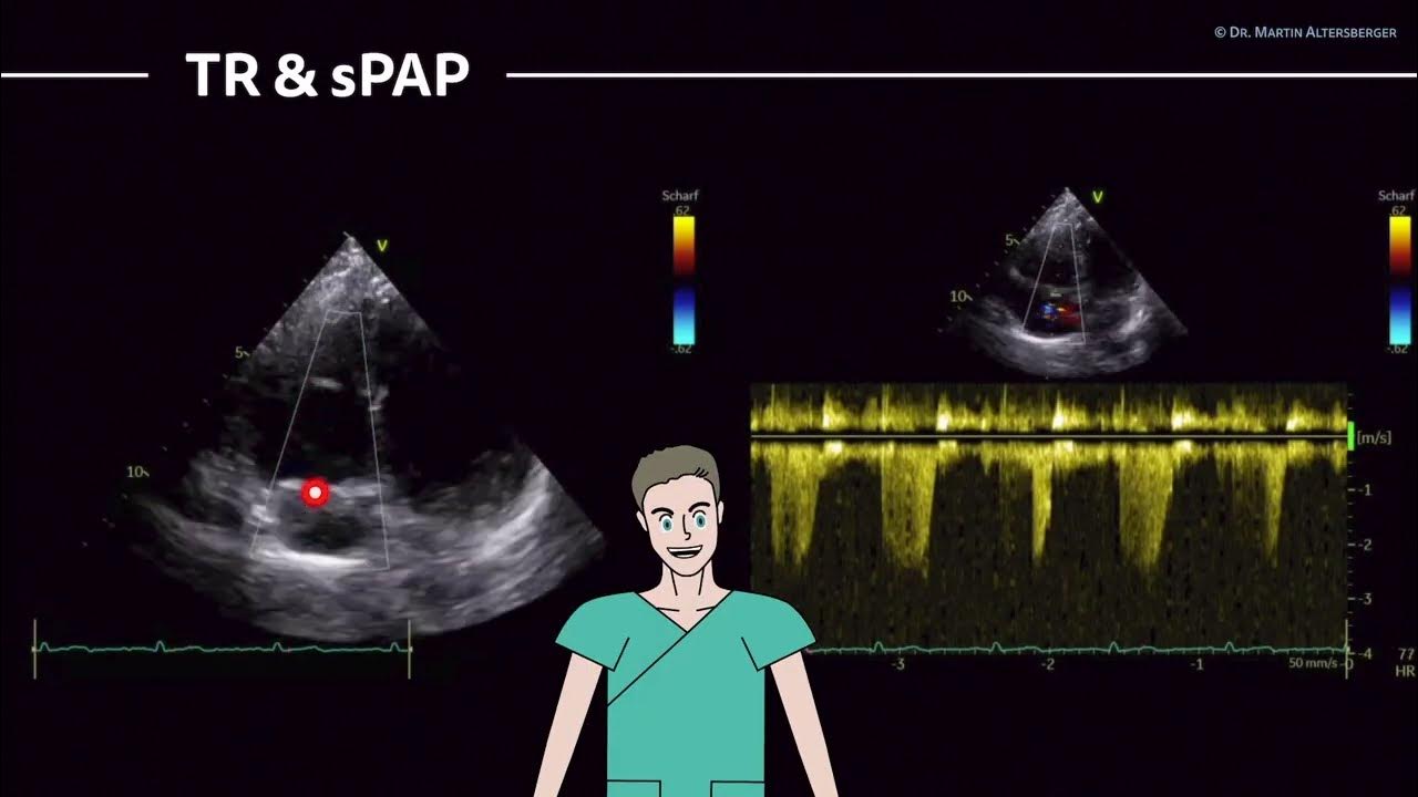 〖Echocardiography〗 PW Doppler MV, TAPSE, sPAP measured in the apical views 💖 YouTube