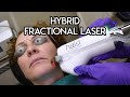 Hybrid Fractional Laser