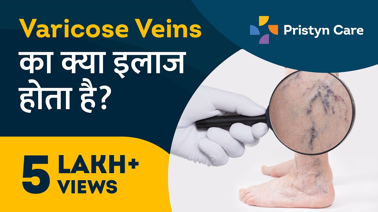 Varicose Veins का क्या इलाज होता है? | 9211990265