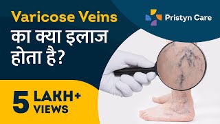 Varicose Veins का क्या इलाज होता है?