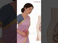 What exactly is Endometriosis Part2 | #drdivyaambavarapu #hyderabad #fertilityclinic #infertilityhyd