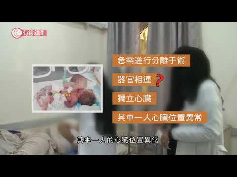 也門連體嬰急需出國治療醫院求援國際 - 20201220 - 兩岸國際 - 有線新聞 CABLE News