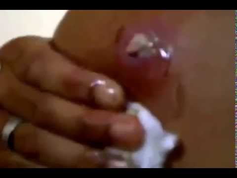 Acne treatment  Puss volcano on my dads back Cysts Extractions This Week 