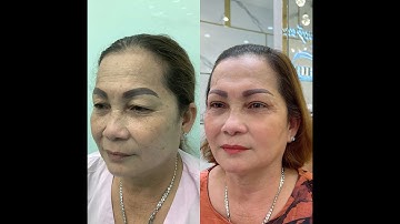 TRẺ RA CHỤC TUỔI VỚI COMBO CẮT TREO VÀ CẮT MÍ TRÊN TẠI THẨM MỸ VIỆN THUỶ TIÊN