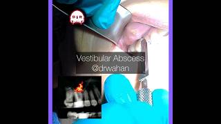 Vestibular Abscess Incision and Drainage
