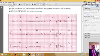25 Examples for Long Strip ECG - Prof. Dr. Mahmoud Allam
