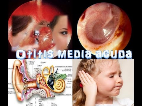 Vídeo: Otitis Media Aguda: Síntomas, Tratamiento, Diagnóstico, Otitis Media Catarral
