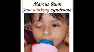 Marcus Gunn jaw winking syndrome #Shorts